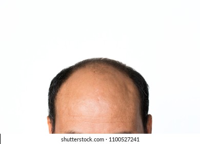 Receding Hairline Images Stock Photos Vectors Shutterstock