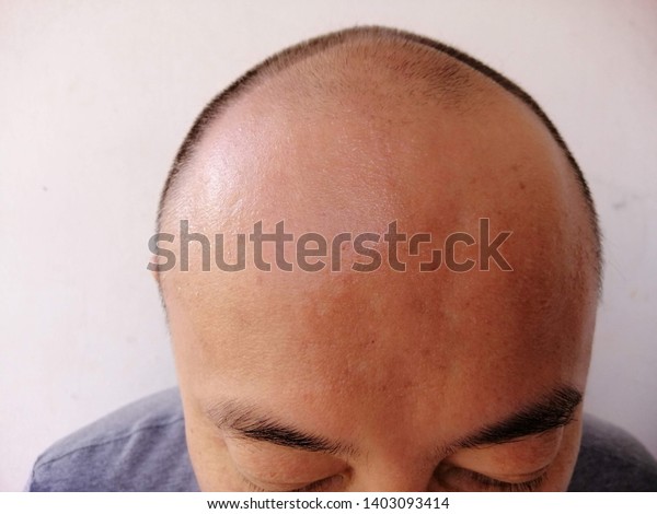 Bald Men Wide Forehead Thin Hair People Healthcare Medical