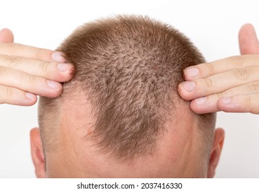 Bald Patches On The Head Of A Young Man. The Concept Of The Increased Hormone Dihydrotestosterone. Weakening Of Hair Follicles