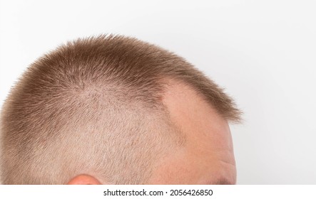 Bald Patches On The Head Of A Young Man. The Concept Of The Increased Hormone Dihydrotestosterone. Weakening Of Hair Follicles, Healthcare