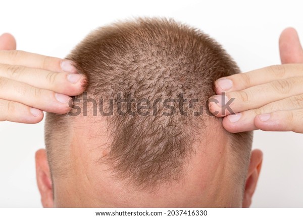 Bald patches on the head of a young man. The\
concept of the increased hormone dihydrotestosterone. Weakening of\
hair follicles