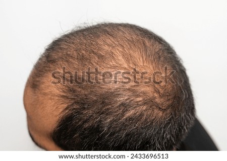 Bald spot on Asian men's head with thin hair and grey hair appear. Conceptual of hair problem on men's head.