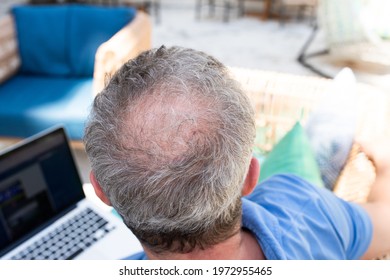A balding man sits outside with a laptop, little hair, alopecia on the crown. Top view. Concept of hair loss in middle aged men.