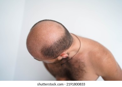 Baldness In An Adult Man, Top View. The Problem Of Hair Loss In Men. Bald Head.