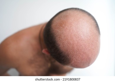 Baldness In An Adult Man, Top View. The Problem Of Hair Loss In Men. Bald Head.