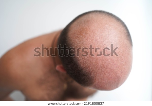 Baldness in an adult man, top view. The problem of\
hair loss in men. Bald\
head.