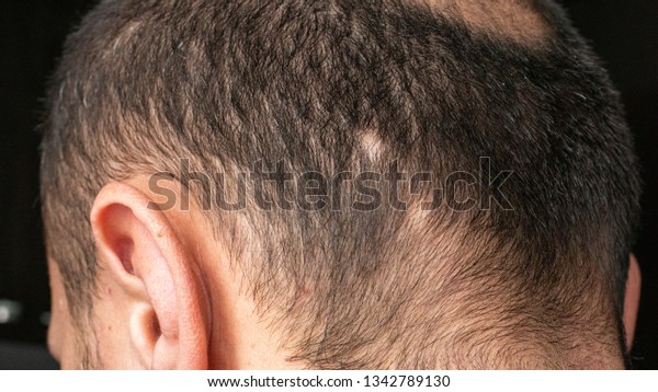 Baldness Head On Back Head Baldness Stock Photo Edit Now 1342789130