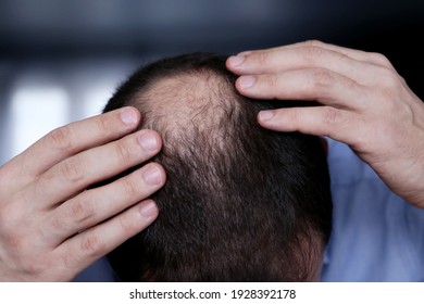 Baldness, Man Concerned About Hair Loss. Male Head With A Bald, Selective Focus On Hand