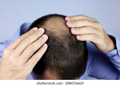 Baldness, Man Concerned About Hair Loss. Male Hands On A Bald Top Of Head