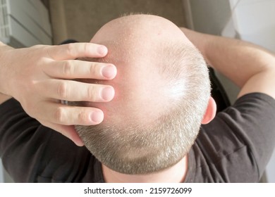 Baldness, man concerned about hair loss. Male head with bald. Male pattern baldness. Fighting hair loss in men - Shutterstock ID 2159726099
