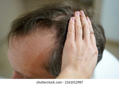 Baldness on the head of a middle-aged man. Hair loss. - Shutterstock ID 2161012987
