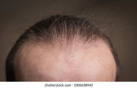 Receding Hairline Images Stock Photos Vectors Shutterstock