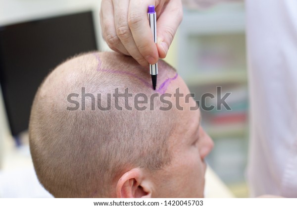 Baldness Treatment Patient Suffering Hair Loss Stock Photo Edit