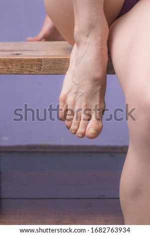 Ballerina foot with beaten nails