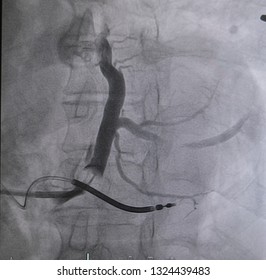 Balloon Catheter Was Inflated Into Coronary Sinus And Contrast Media Injection For Coronary Sinus Was Performed In CRT-D Implantation.