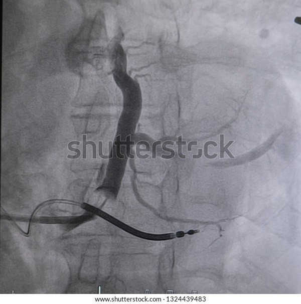 Balloon catheter was inflated into coronary
sinus and contrast media injection for coronary sinus was performed
in CRT-D implantation.