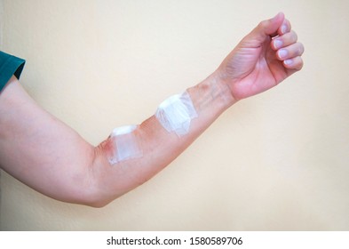 The Bandage From Hemodialysis To The Arm From The Treatment Of Dialysis Through A Blood Vessel 