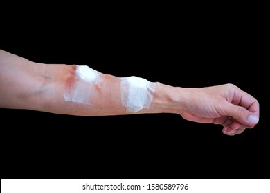 The Bandage From Hemodialysis To The Arm From The Treatment Of Dialysis Through A Blood Vessel With Colors Black Background