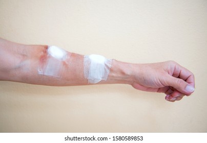 The Bandage From Hemodialysis To The Arm From The Treatment Of Dialysis Through A Blood Vessel 