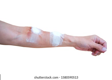 The Bandage From Hemodialysis To The Arm From The Treatment Of Dialysis Through A Blood Vessel With Colors White Background