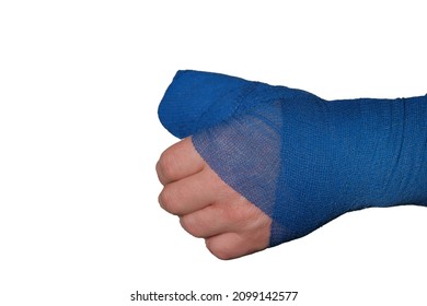 Bandaged Hand Isolated On White Background.Broken Arm. Blue Surgical Bandage On The Arm.Fractures,sprains And Bandages.Medicine Concept. Surgical Dressing. 