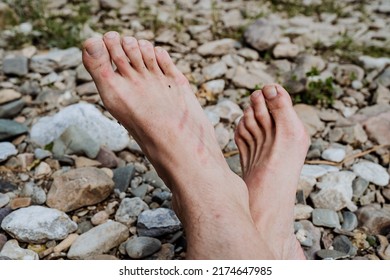 Bare Feet Against The Background Of Stones, Part Of The Human Body Legs Lie On The Bank Of The River, Red Stripes From The Burn On The Leg. High Quality Photo