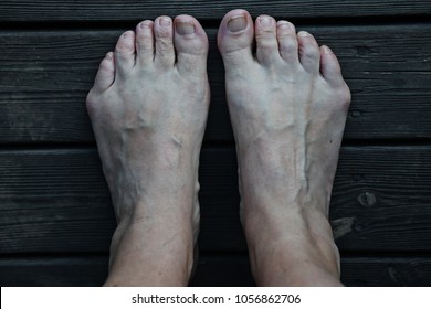 Bare Feet With The Condition Tailor's Bunion At The Base Of The Little Toes.