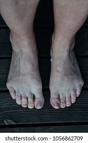 Bare Feet With The Condition Tailor's Bunion At The Base Of The Little Toes.