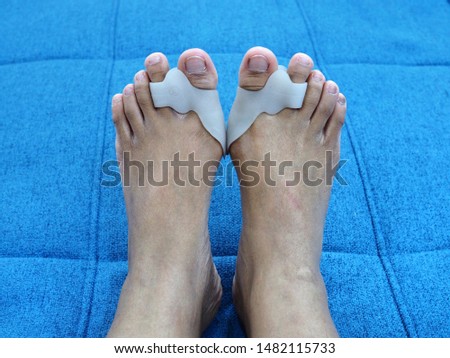 Bare foots which have Hallux Valgus (bunion) problem on blue sofa bed. A deformity of the joint connecting the big toe to the foot and caused painful.