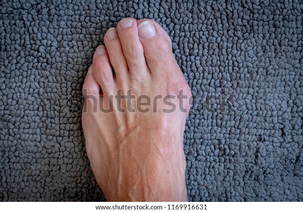 bunions on men's feet