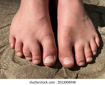 Barefoot young boy with webbed toe, syndactyly of the middle toes on right foot. Genetic congenital conditions and common birth abnormalities.