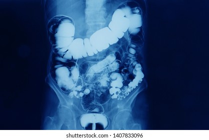 Barium Enema Abdomen Xray Showing Contrast Stock Photo 1407833096 ...