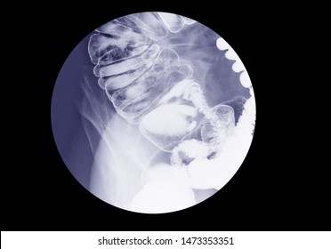 Barium Enema Examination Spot Film (lower Gastrointestinal (GI))