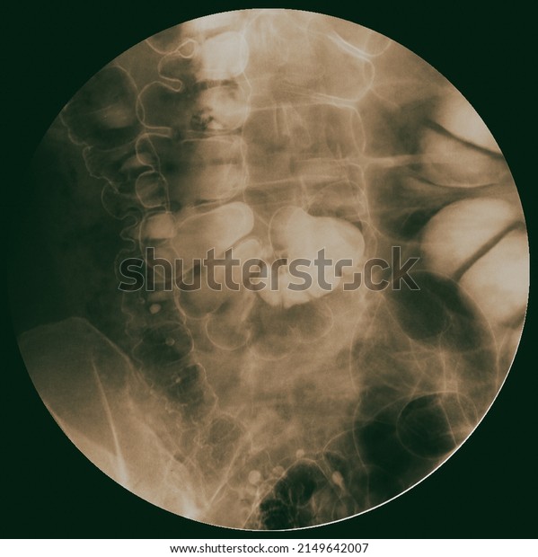 Barium enema image or x-ray image of large\
intestine or colon showing anatomical of large intestine and\
appendix for diagnosis Colorectal\
cancer.