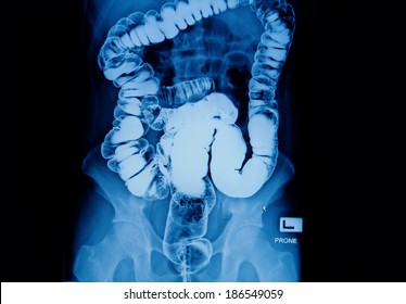 Barium Enema Of A Man Demonstrated The Normal Rectum And Cecum