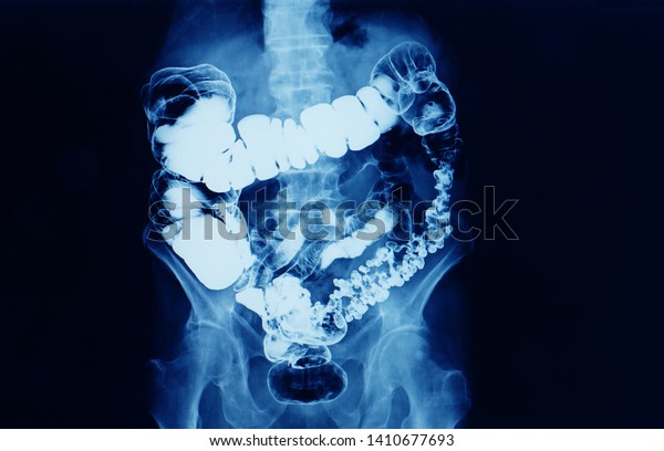 barium\
enema x-ray showing contrast fill in most part of large intestine\
such as transverse colon, sigmoid colon and rectum. the patient has\
colon cancer. medical film on dark\
background