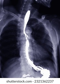 Barium Swallow study test diagnose Barrett's GI tract exam GERD ulcers series difficulty pharynx procedure UGI throat bowel therapy by fluoroscopy devices.