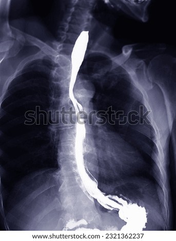 Barium Swallow study test diagnose Barrett's GI tract exam GERD ulcers series difficulty pharynx procedure UGI throat bowel therapy by fluoroscopy devices.