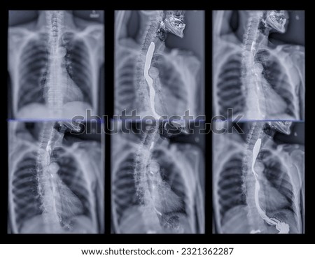 Barium Swallow study test diagnose Barrett's GI tract exam GERD ulcers series difficulty pharynx procedure UGI throat bowel therapy by fluoroscopy devices.