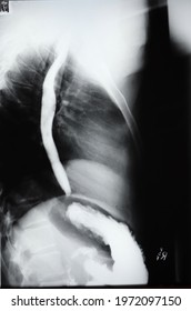 A Barium Swallow X-Ray In A 27 Year Old Female With Heartburn, Pain And Indigestion.