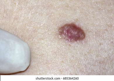 Basal Cell Carcinoma