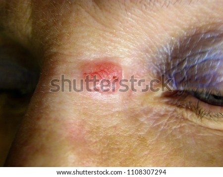 Basal cell carcinoma on the skin of the face. Skin Cancer.