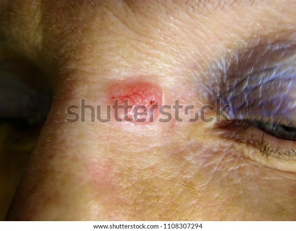 Basal cell carcinoma on the skin of the face.\
Skin Cancer.