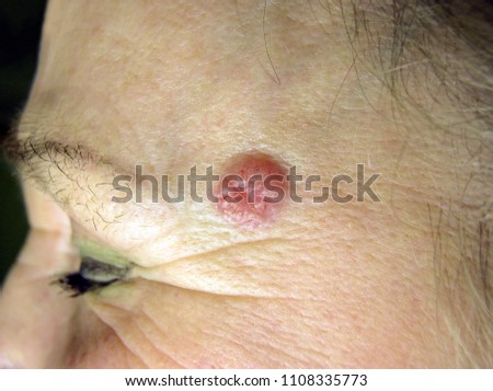 basal cell carcinoma of the skin, temporal region of the face