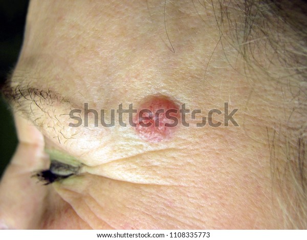 basal cell carcinoma of the skin, temporal region of\
the face