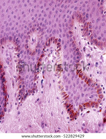 Basal layer of skin epidermis. Numerous melanocytes loaded with brown melanin granules. Light microscope micrograph. H&E stain