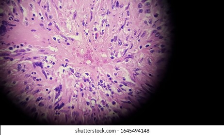 Basidiobolus Fungal Hyphae In Colon Biopsy Specimen