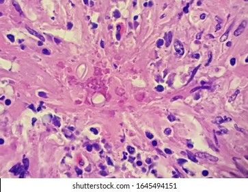 Basidiobolus Fungal Hyphae In Colon Biopsy Specimen