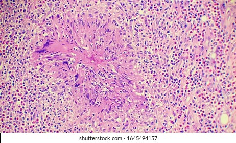 Basidiobolus Fungal Hyphae In Colon Biopsy Specimen