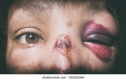 Battered woman with bruise on eye